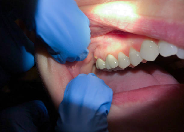 Best Emergency Dentist for Lost Fillings or Crowns in West Point, VA